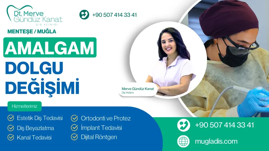 Muğla'da amalgam dolgu değişimi - eski metal dolguların modern beyaz kompozit dolgularla yenilenmesi
