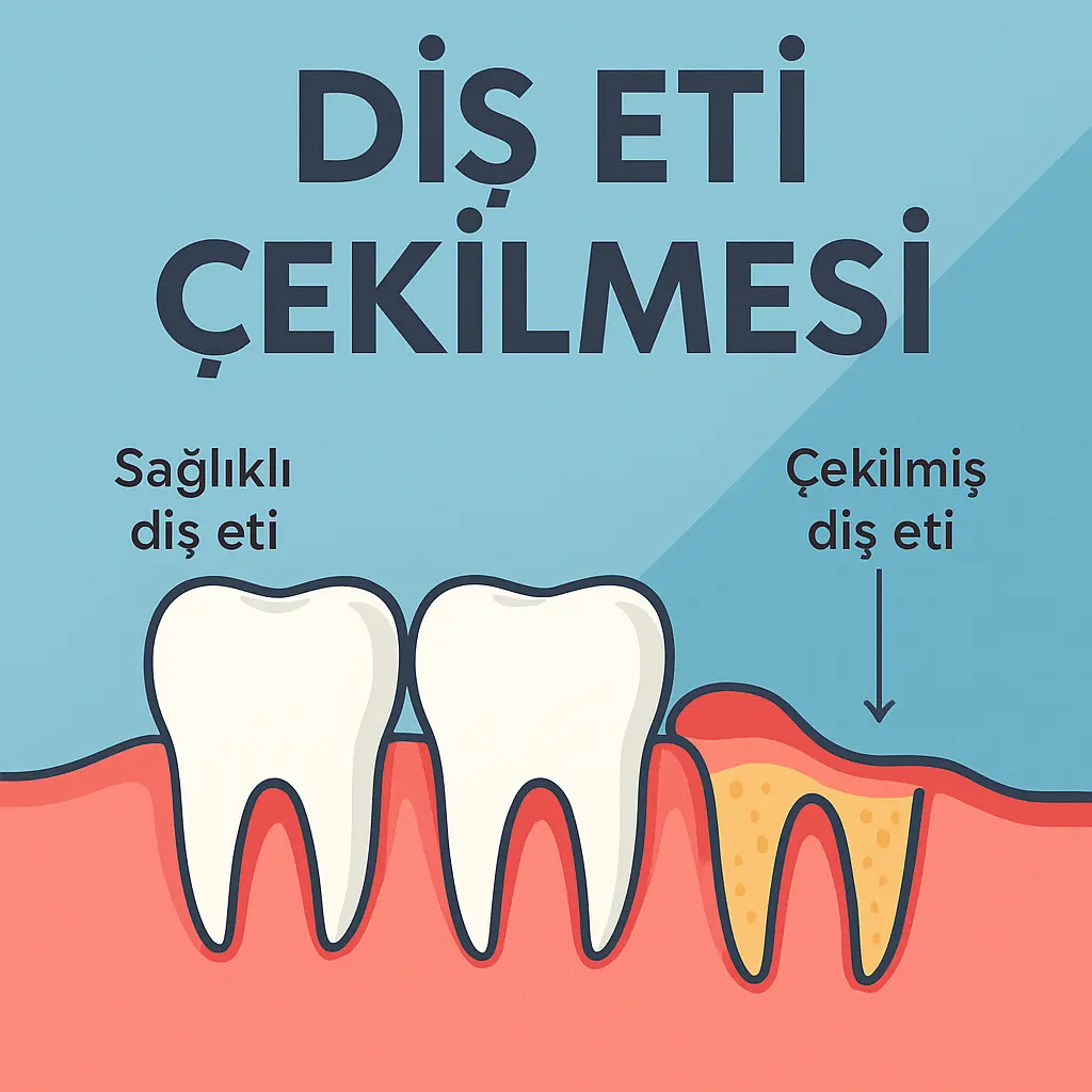 Diş eti çekilmesi neden olur, nasıl geçer – diş eti çekilmiş ön dişlerin görünümü