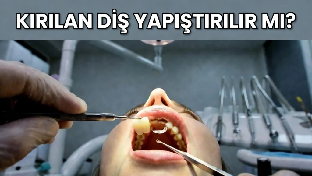 Kırılan diş yapıştırılır mı? Kırık ön diş bonding ile yapıştırılıyor, Dt. Merve Gündüz Kanat Diş Kliniği'nde tedavi öncesi görünüm – Muğla Menteşe diş hekimi