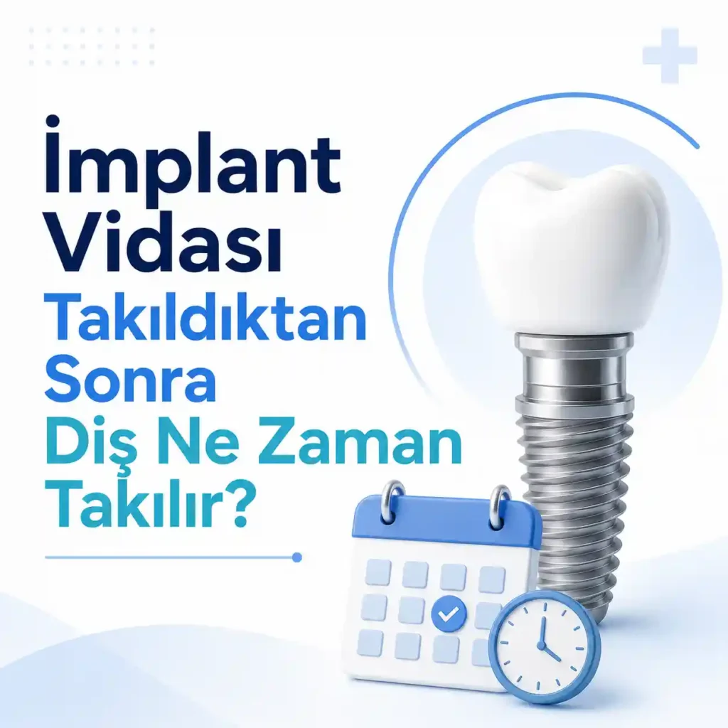 İmplant vidası takıldıktan sonra diş ne zaman takılır sorusunu açıklayan implant üstü diş görseli